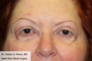 Upper Blepharoplasty Clear Lake Post 7