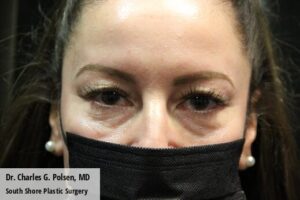 Upper Blepharoplasty Clear Lake Pre 6