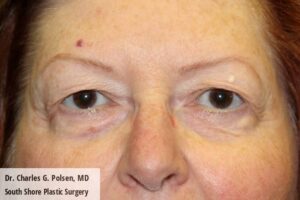 Upper Blepharoplasty Clear Lake Pre 7